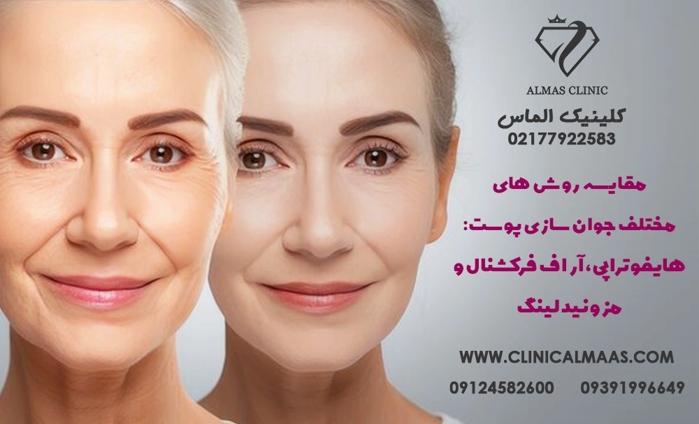 مقایسه روش‌های مختلف جوان‌سازی پوست: هایفوتراپی، آر اف فرکشنال و مزونیدلینگ